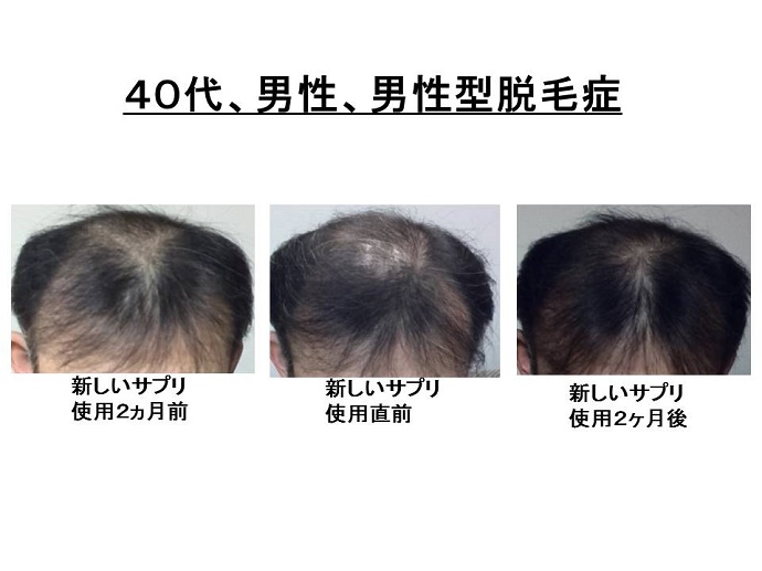 円形脱毛症　病院""
